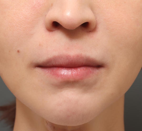 30代女性の人中短縮（リップリフト） Before 症例写真