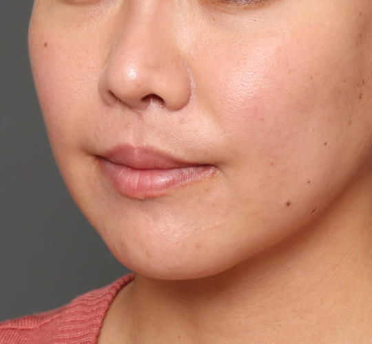 30代女性の人中短縮（リップリフト） After 症例写真