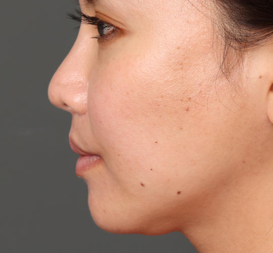 30代女性の人中短縮（リップリフト） After 症例写真