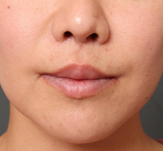 30代女性の人中短縮（リップリフト） After 症例写真