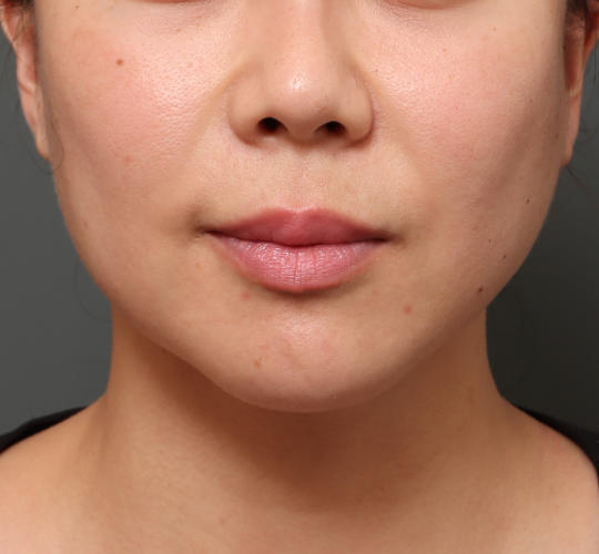 30代女性の人中短縮(リップリフト) Before 症例写真