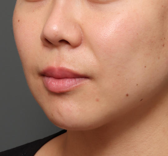 30代女性の人中短縮（リップリフト） Before 症例写真