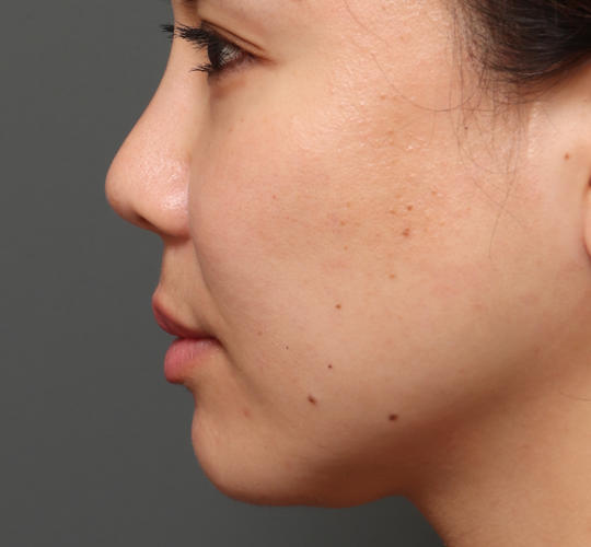 30代女性の人中短縮（リップリフト） Before 症例写真