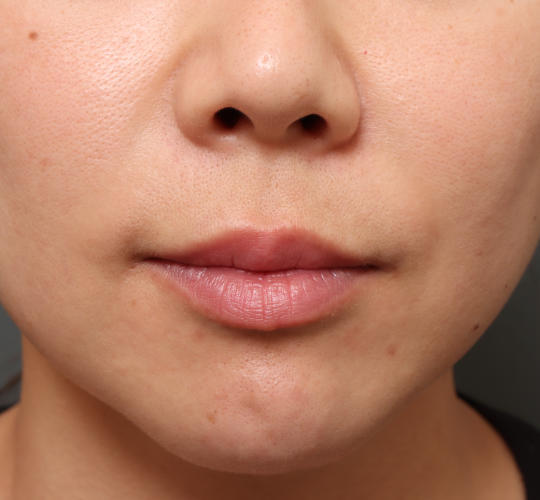 30代女性の人中短縮（リップリフト） Before 症例写真
