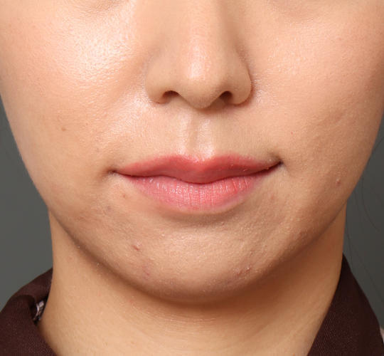 20代女性の唇・口元の整形 Before 症例写真