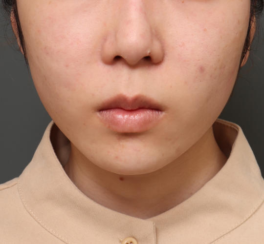 20代女性の口角挙上(スマイルリップ) Before 症例写真