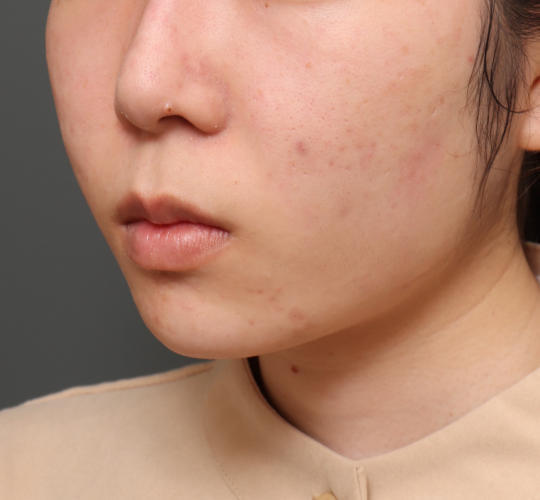 20代女性の口角挙上(スマイルリップ) Before 症例写真