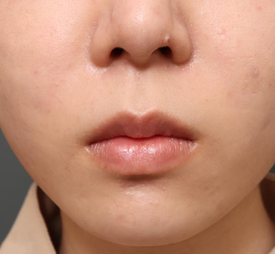 20代女性の口角挙上(スマイルリップ) Before 症例写真