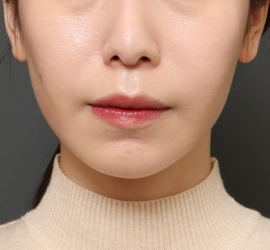 20代女性の顔の脂肪吸引  After 症例写真