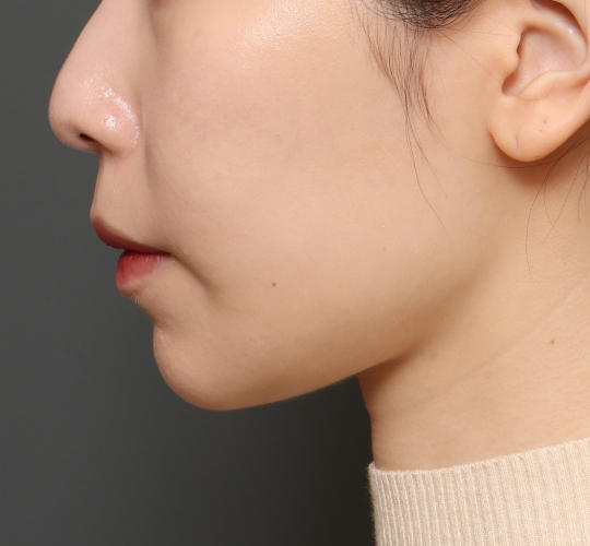 20代女性の顔の脂肪吸引  After 症例写真