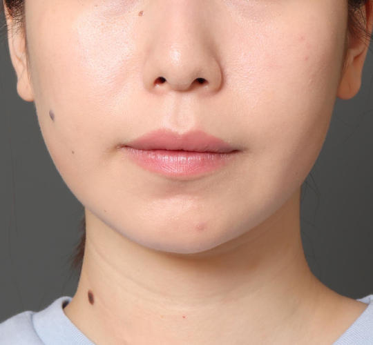 20代女性の顔の脂肪吸引  Before 症例写真