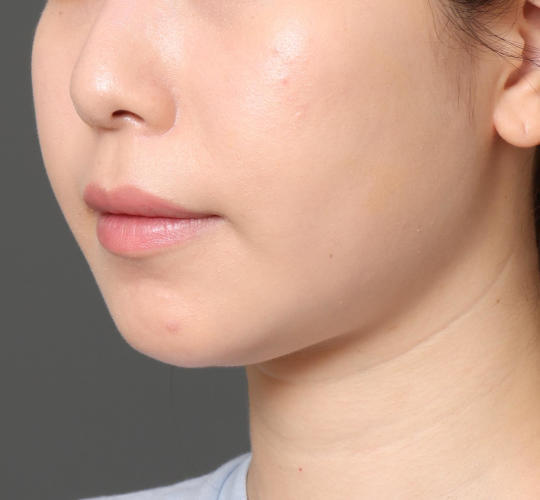 20代女性の顔の脂肪吸引  Before 症例写真