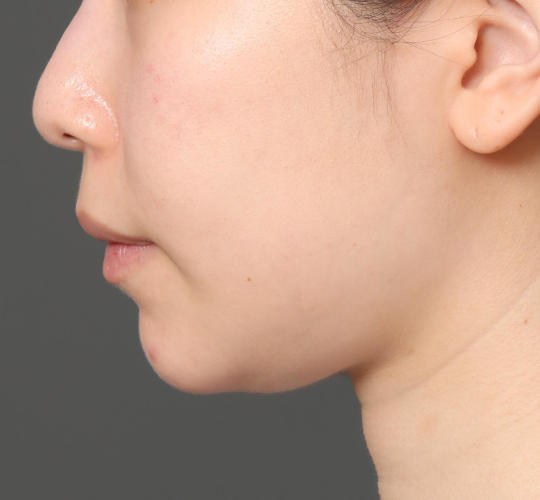 20代女性の顔の脂肪吸引  Before 症例写真