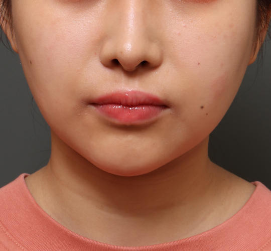 20代女性のメーラーファット除去 After 症例写真