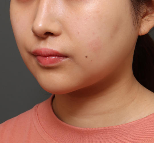 20代女性のメーラーファット除去 After 症例写真