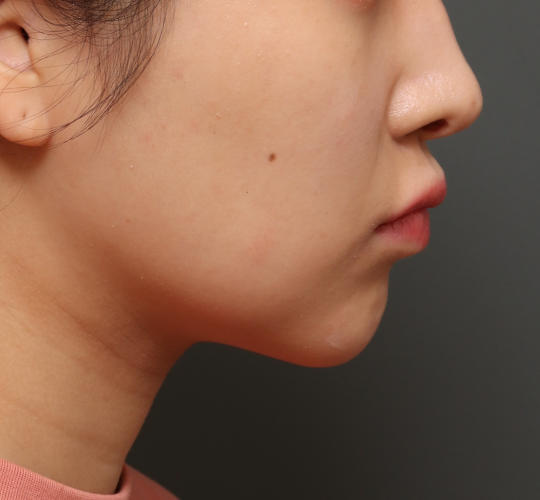 20代女性のメーラーファット除去 After 症例写真