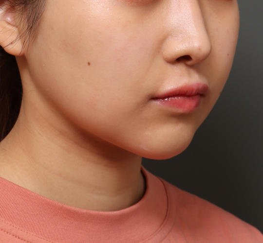 20代女性のVOVリフトプレミアム After 症例写真