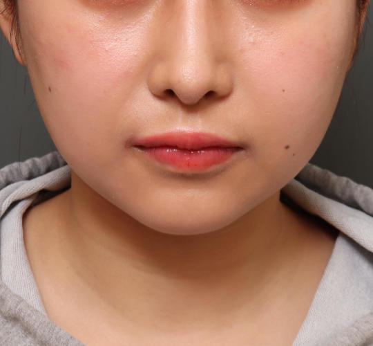 20代女性のメーラーファット除去 Before 症例写真