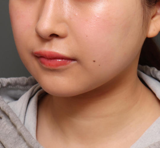 20代女性のメーラーファット除去 Before 症例写真