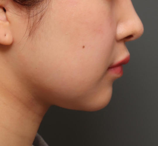 20代女性のメーラーファット除去 Before 症例写真