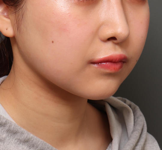 20代女性のVOVリフトプレミアム Before 症例写真