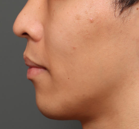 20代男性のメーラーファット除去 Before 症例写真