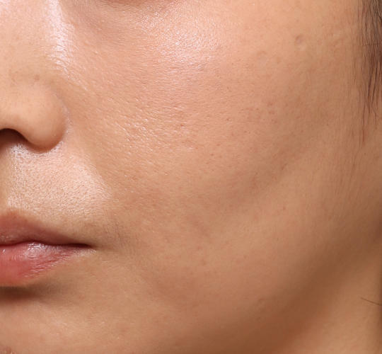 30代女性のメーラーファット除去 After 症例写真