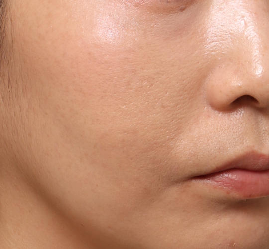 30代女性のVOVリフトプレミアム After 症例写真