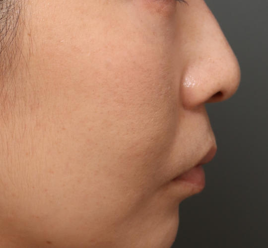 30代女性のメーラーファット除去 After 症例写真