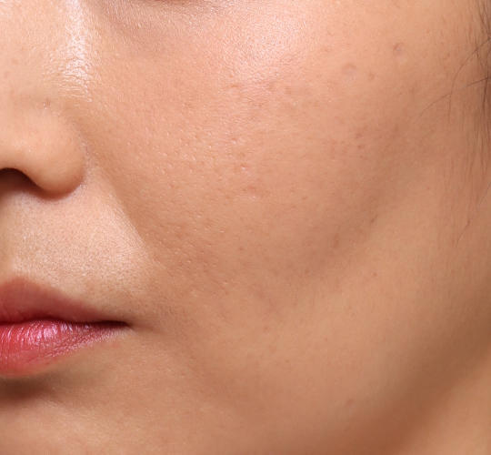 30代女性のメーラーファット除去 Before 症例写真