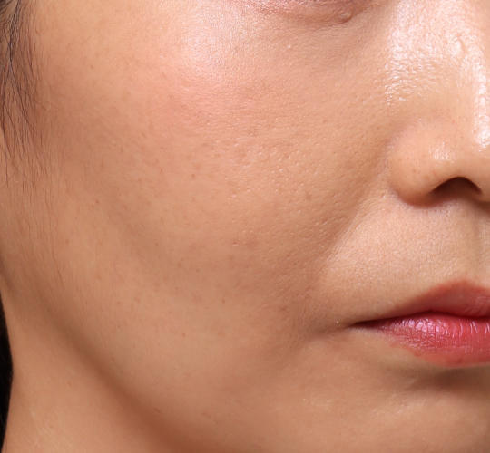 30代女性のVOVリフトプレミアム Before 症例写真