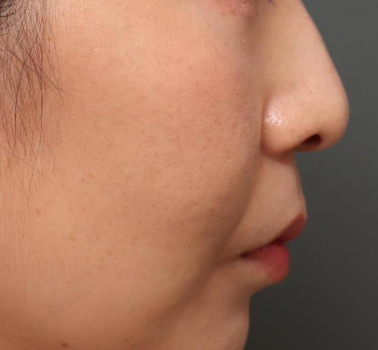 30代女性のメーラーファット除去 Before 症例写真