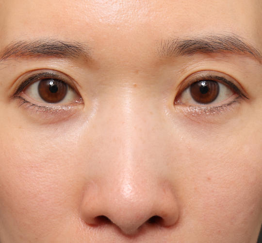 30代女性の眉下切開法 After 症例写真