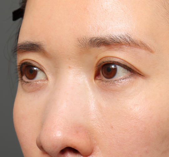 30代女性の眉下切開法 After 症例写真