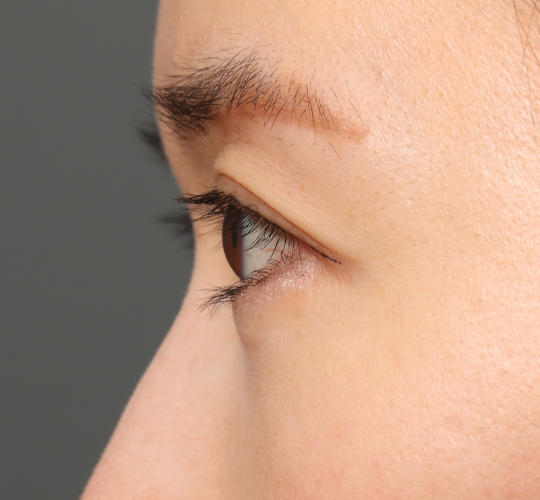 30代女性の眉下切開法 After 症例写真