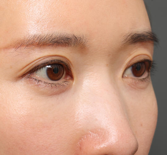 30代女性の眉下切開法 After 症例写真