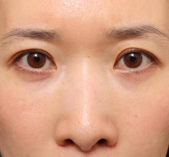 30代女性の眉下切開法 Before 症例写真