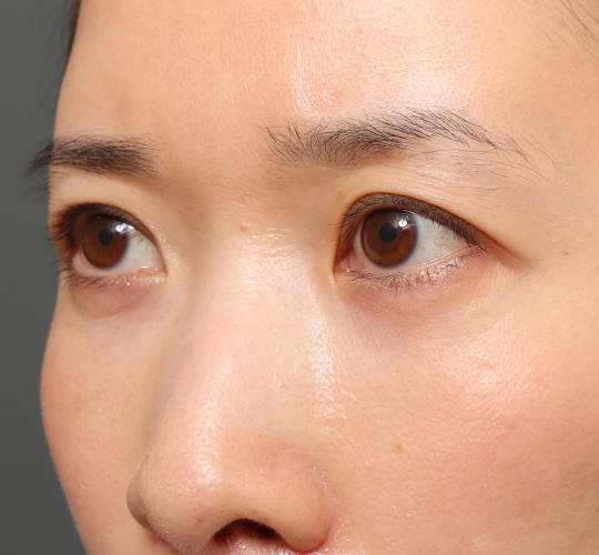 30代女性の眉下切開法 Before 症例写真