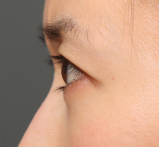 30代女性の眉下切開法 Before 症例写真