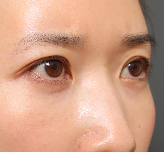 30代女性の眉下切開法 Before 症例写真