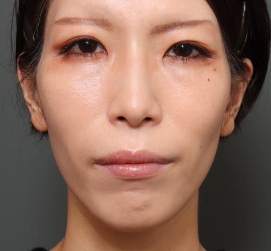 30代女性の眉下切開法 Before 症例写真