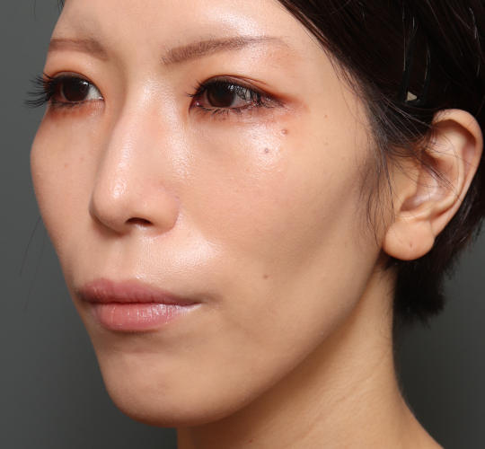 30代女性の鼻翼縮小(小鼻縮小) Before 症例写真