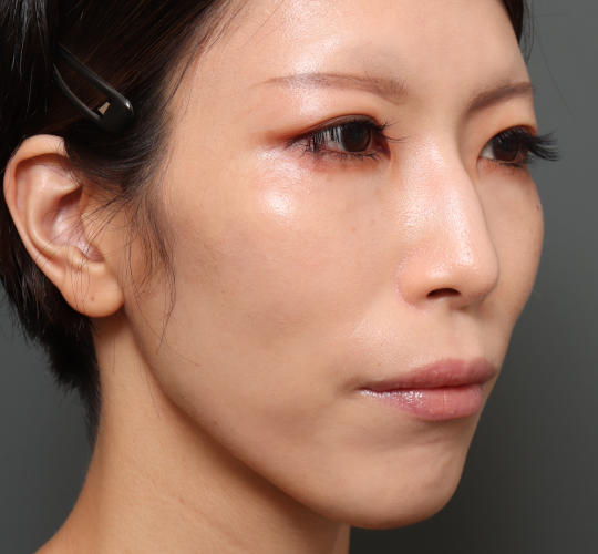 30代女性の鼻翼縮小(小鼻縮小) Before 症例写真