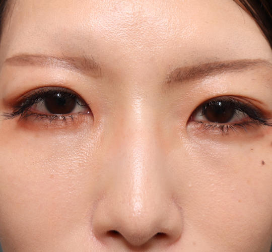 30代女性の鼻翼縮小(小鼻縮小) Before 症例写真