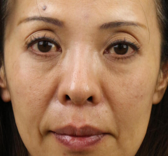 40代女性のヒアルロン酸注射(目の下) After 症例写真
