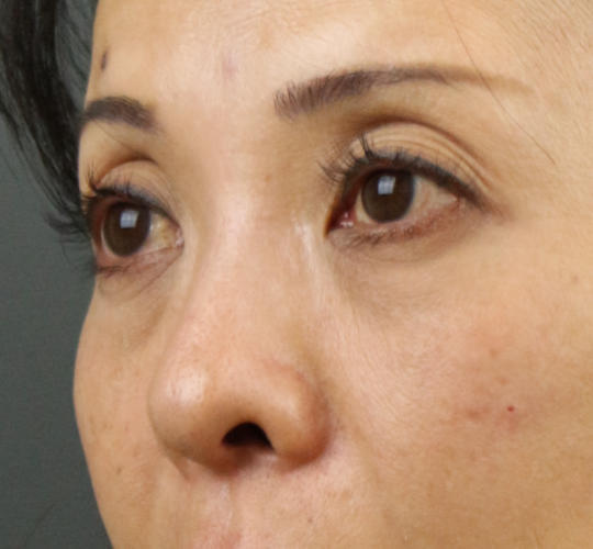 40代女性のヒアルロン酸注射（目の下） After 症例写真