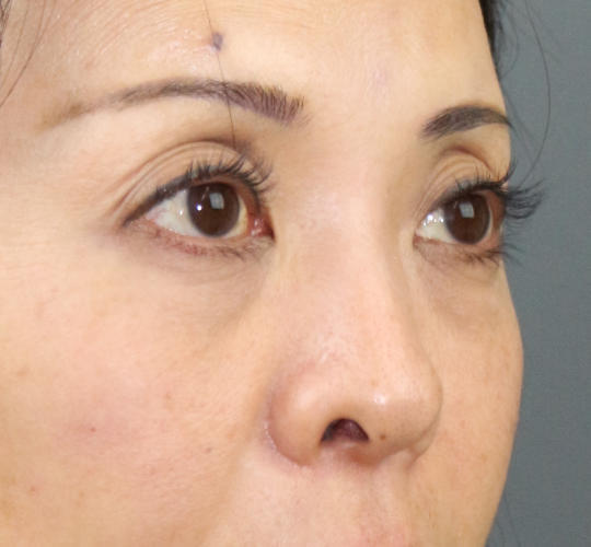 40代女性のヒアルロン酸注射（目の下） After 症例写真