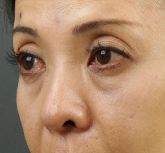 40代女性のヒアルロン酸注射（目の下） Before 症例写真