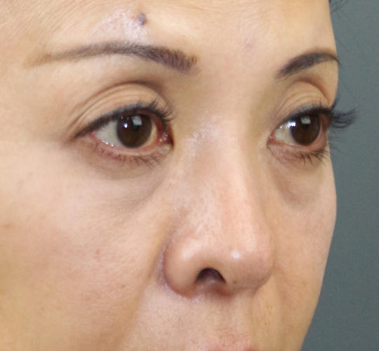 40代女性のヒアルロン酸注射（目の下） Before 症例写真