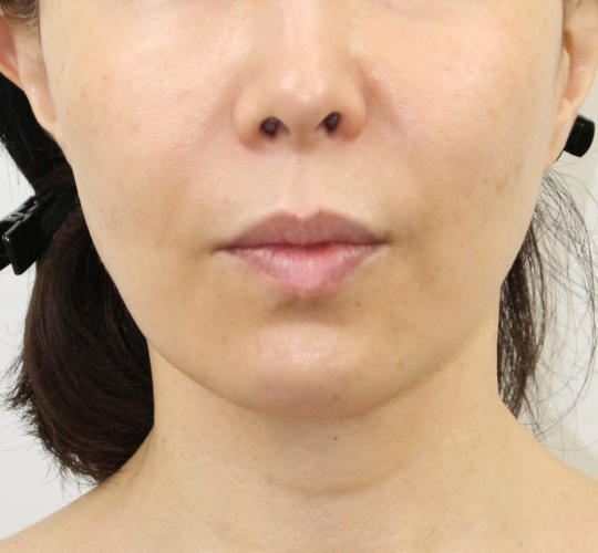 50代女性のVOVリフトプレミアム After 症例写真